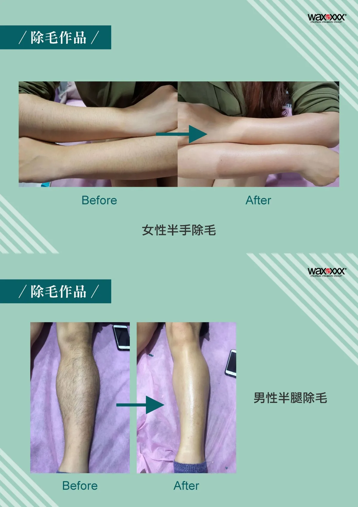 時尚Q除毛作品：女性半手除毛與男性半腿除毛前後對比