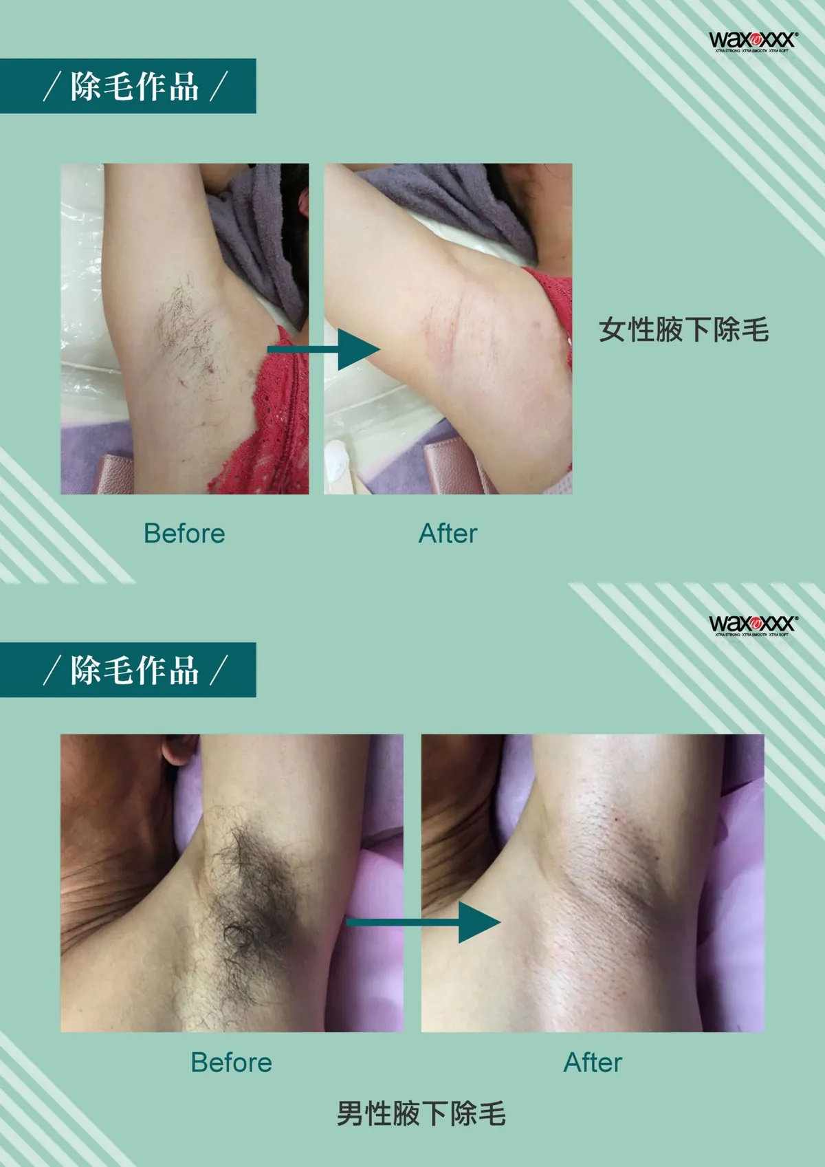 時尚Q除毛作品：女性腋下除毛與男性腋下除毛前後對比