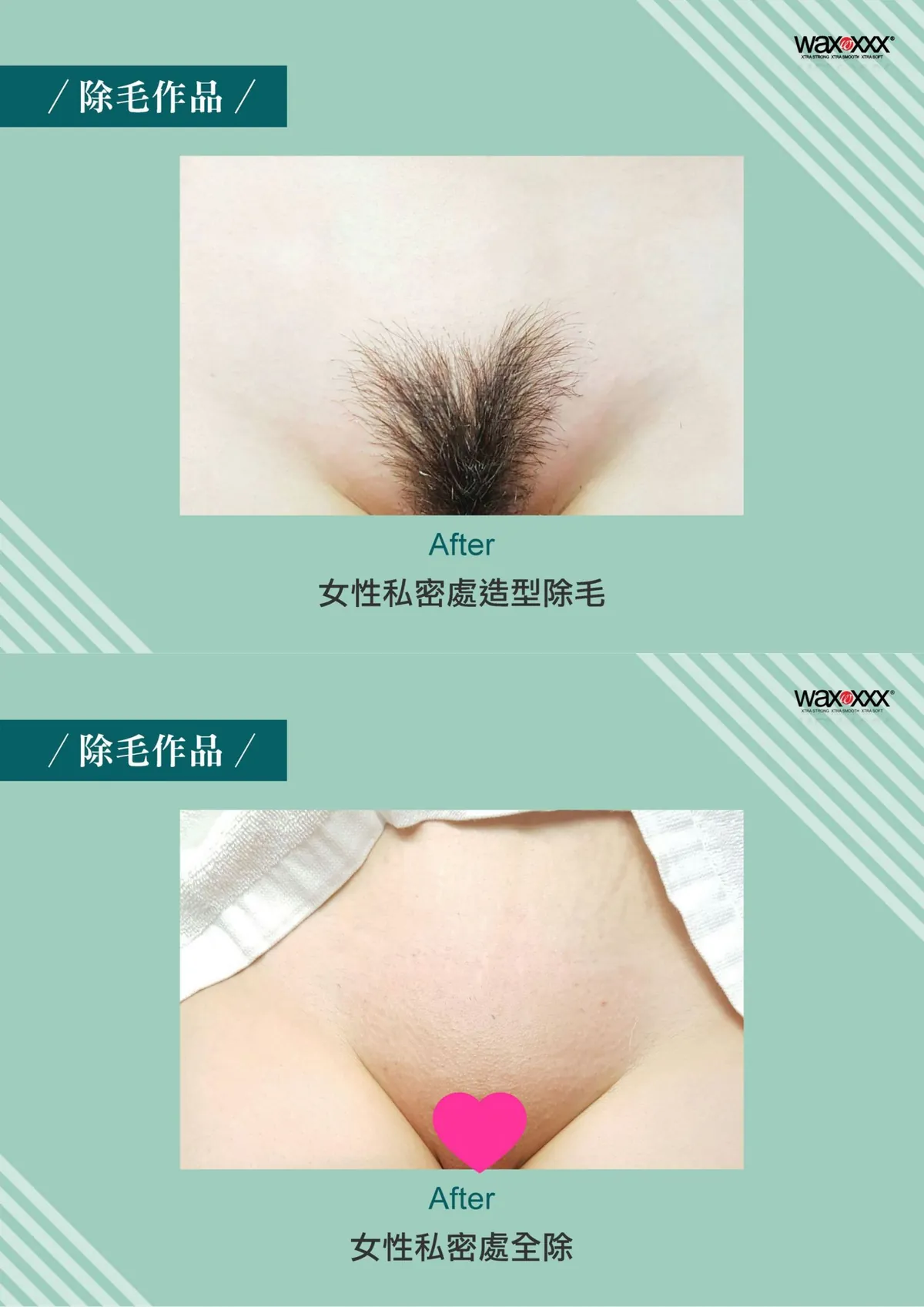 時尚Q除毛作品：女性私密處造型除毛與全除施作成果