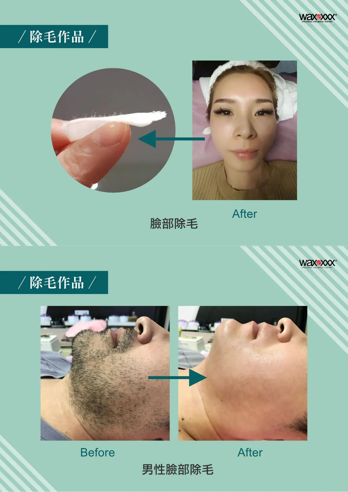 時尚Q除毛作品：女性臉部除毛與男性臉部鬍鬚除毛前後對比